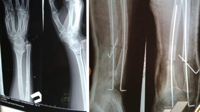 Шымкенттік дәрігерлер қисайған сүйекке алғаш рет ота жасады