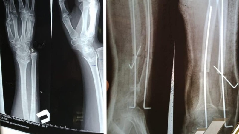 Шымкенттік дәрігерлер қисайған сүйекке алғаш рет ота жасады